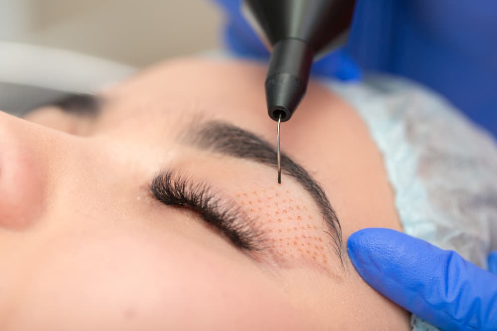 Blefaroplastia No Quirúrgica con Láser de CO2
